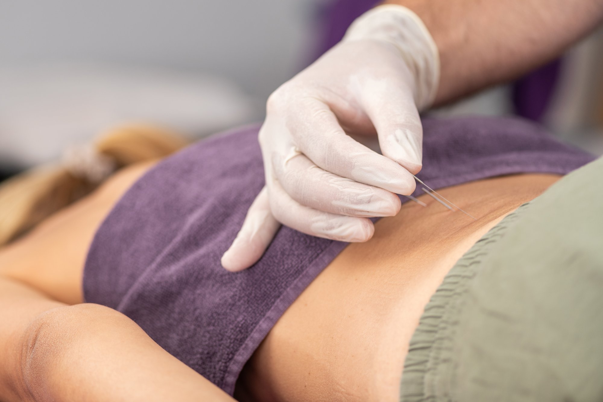 physical-therapist-performing-dry-needling-on-a-pa-2024-12-03-22-24-22-utc